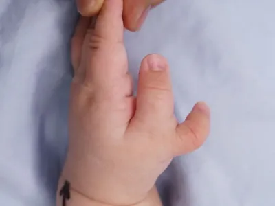 If you were to rate your baby's thumb after surgery, what score would you giv...