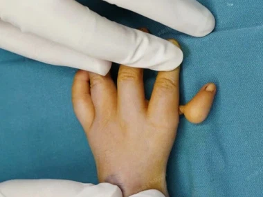 Should a “floating” thumb in a baby be removed or preserved?