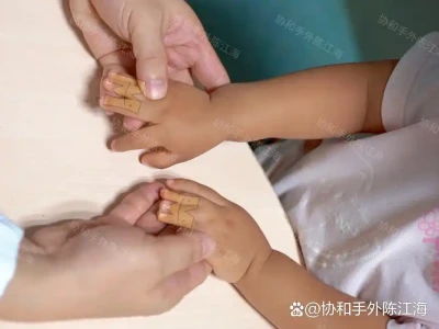 Bilateral Synpolydactyly Corrected in One Surgery — No Impact on Daily Activi...
