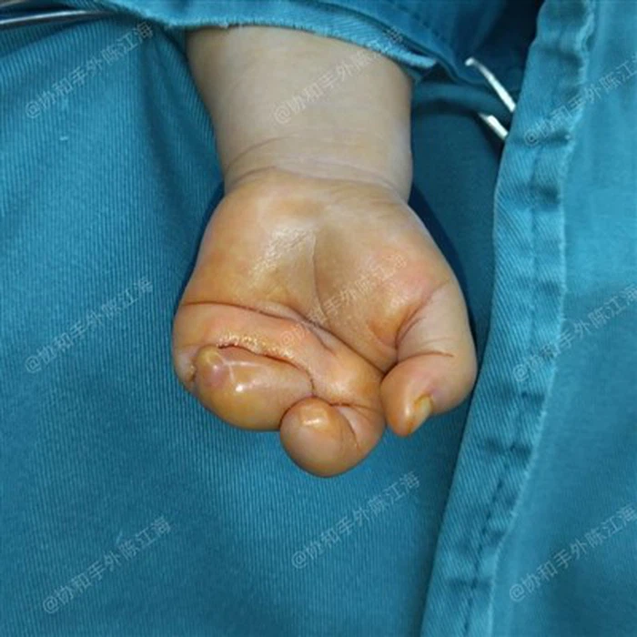 Amniotic Band Syndrome Surgery Amniotic Band Syndrome Surgery